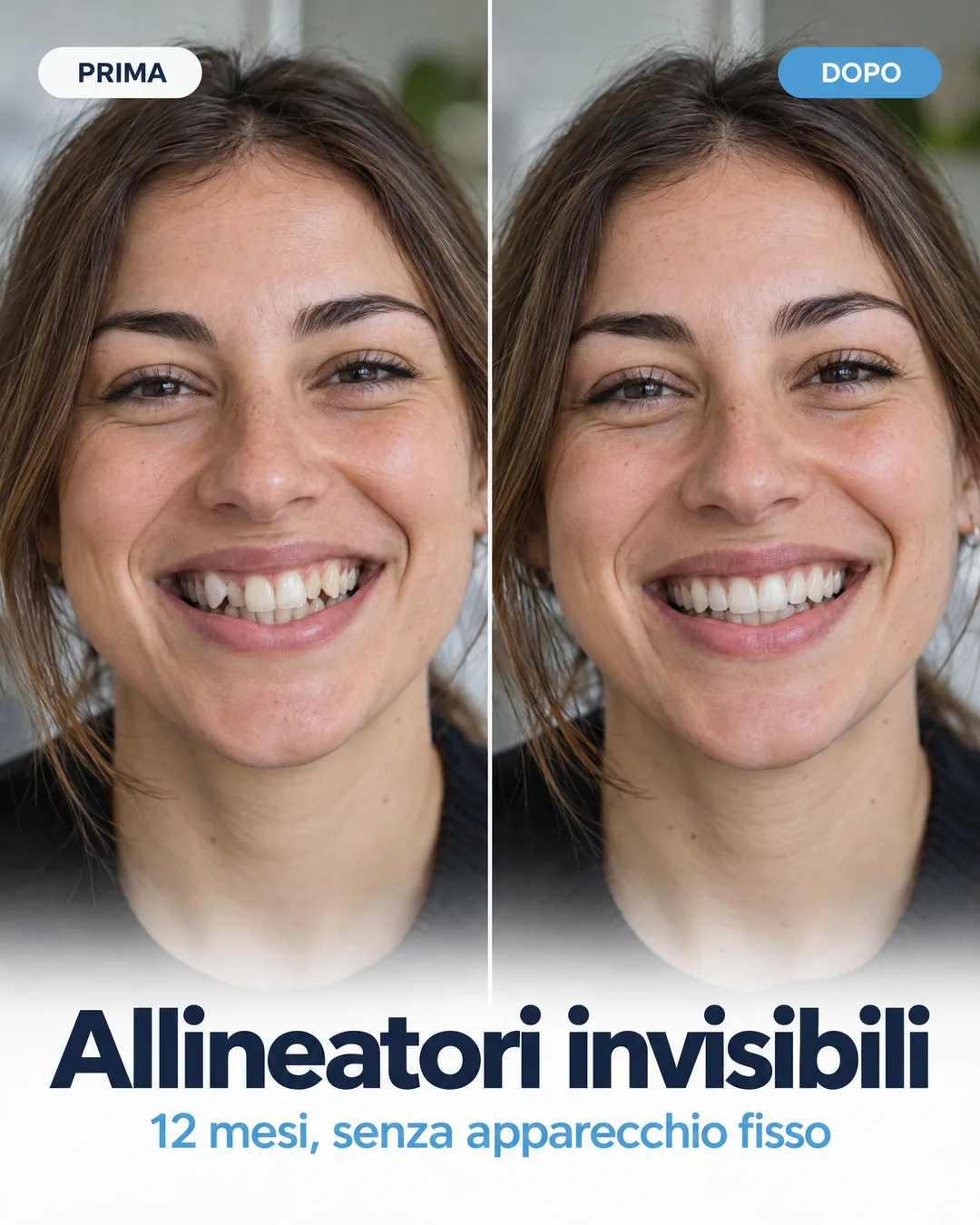 prima e dopo con gli allineatori invisibili